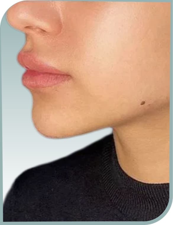 Jaw and neck contour, After photo (result 1 of 6)