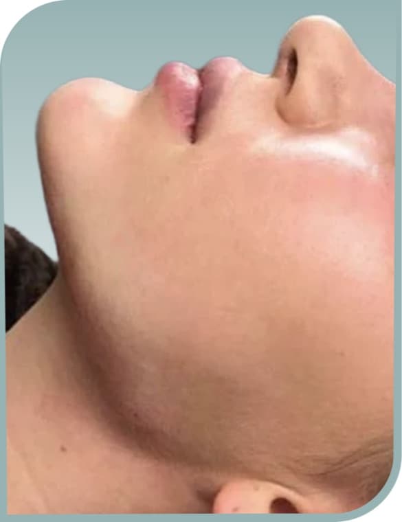 Submental contour, After photo (result 2 of 6)