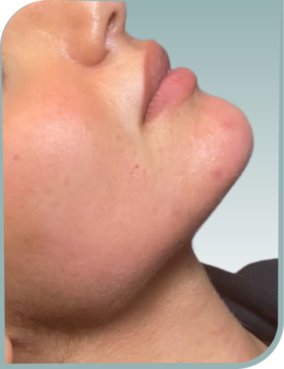 Jawline definition, After photo (result 7 of 10)