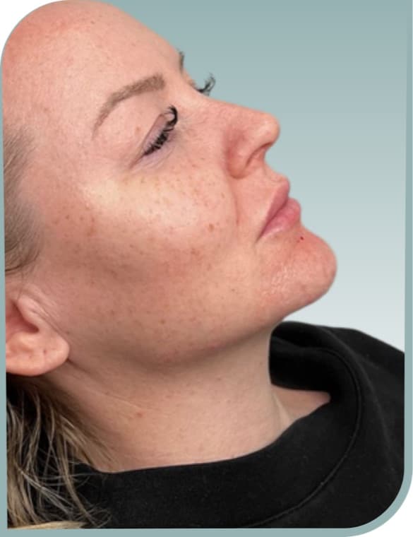 Jawline definition, After photo (result 4 of 6)