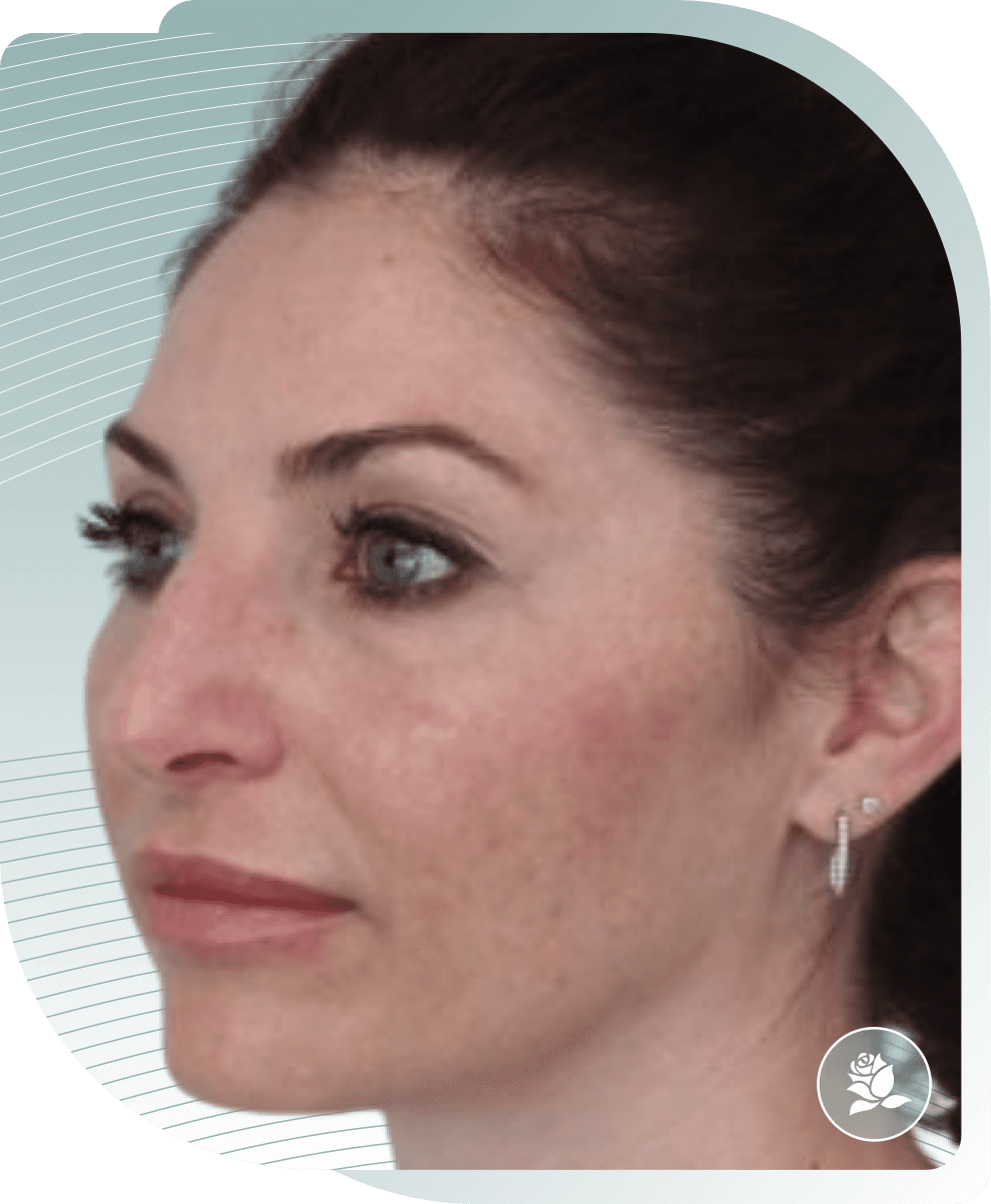 THREAD LIFT RESULTS — After photo (result 1 of 4)
