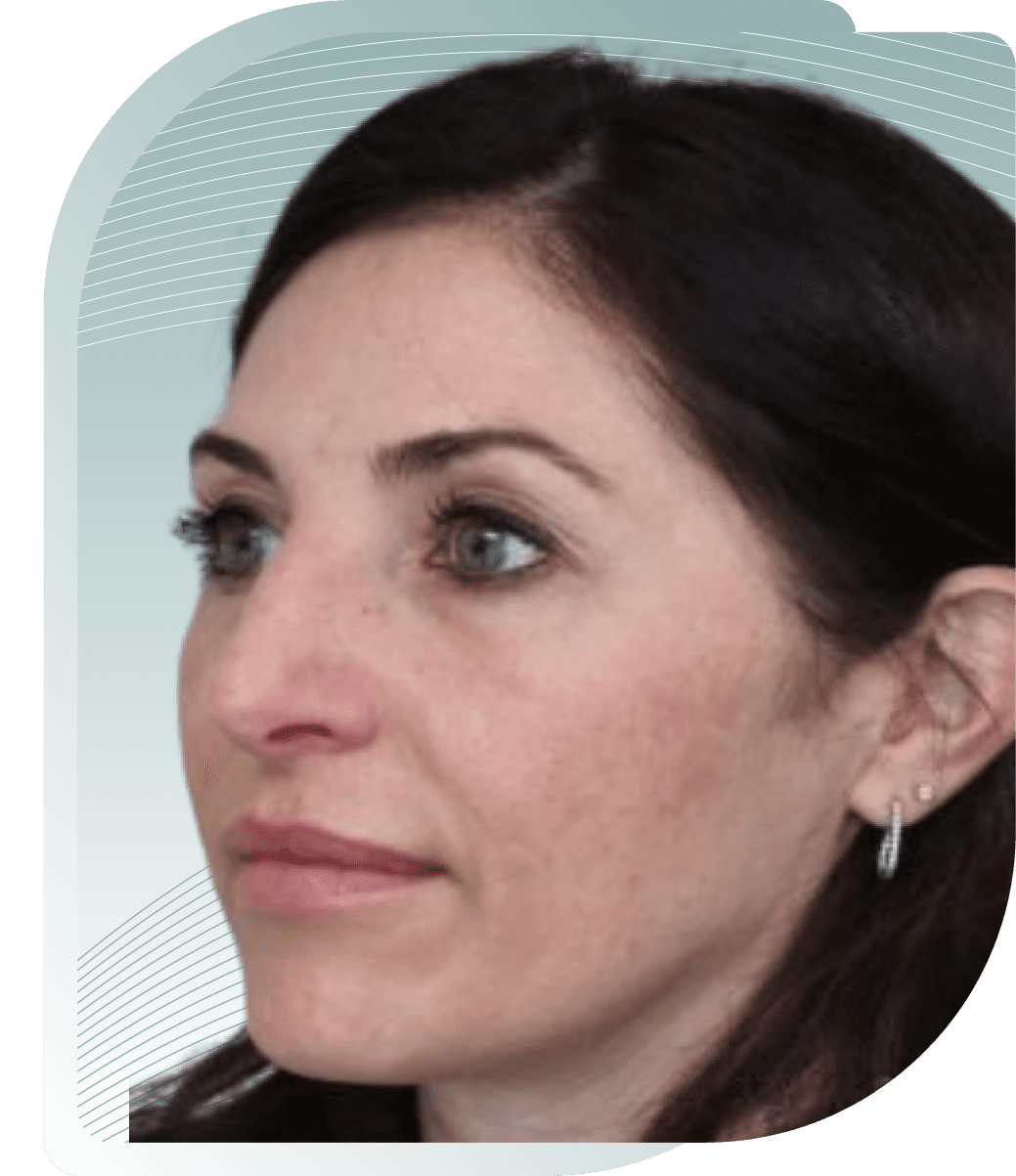 ULTIMATE FACELIFT RESULTS — Before photo (result 1 of 4)