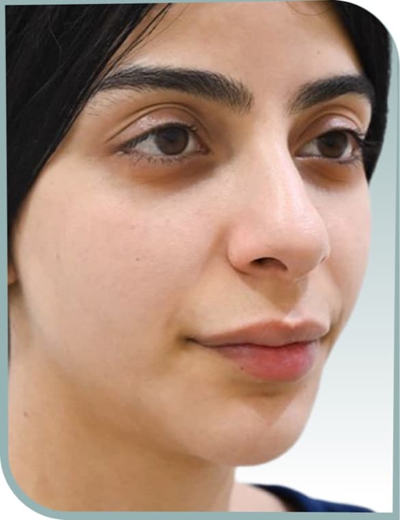 Under-eye and mid face, Before photo (result 10 of 10)