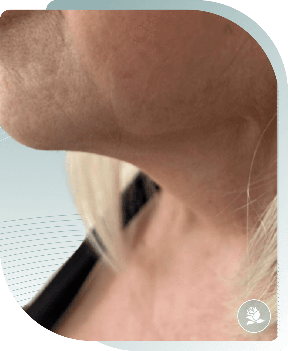 ULTIMATE FACELIFT RESULTS — After photo (result 2 of 4)