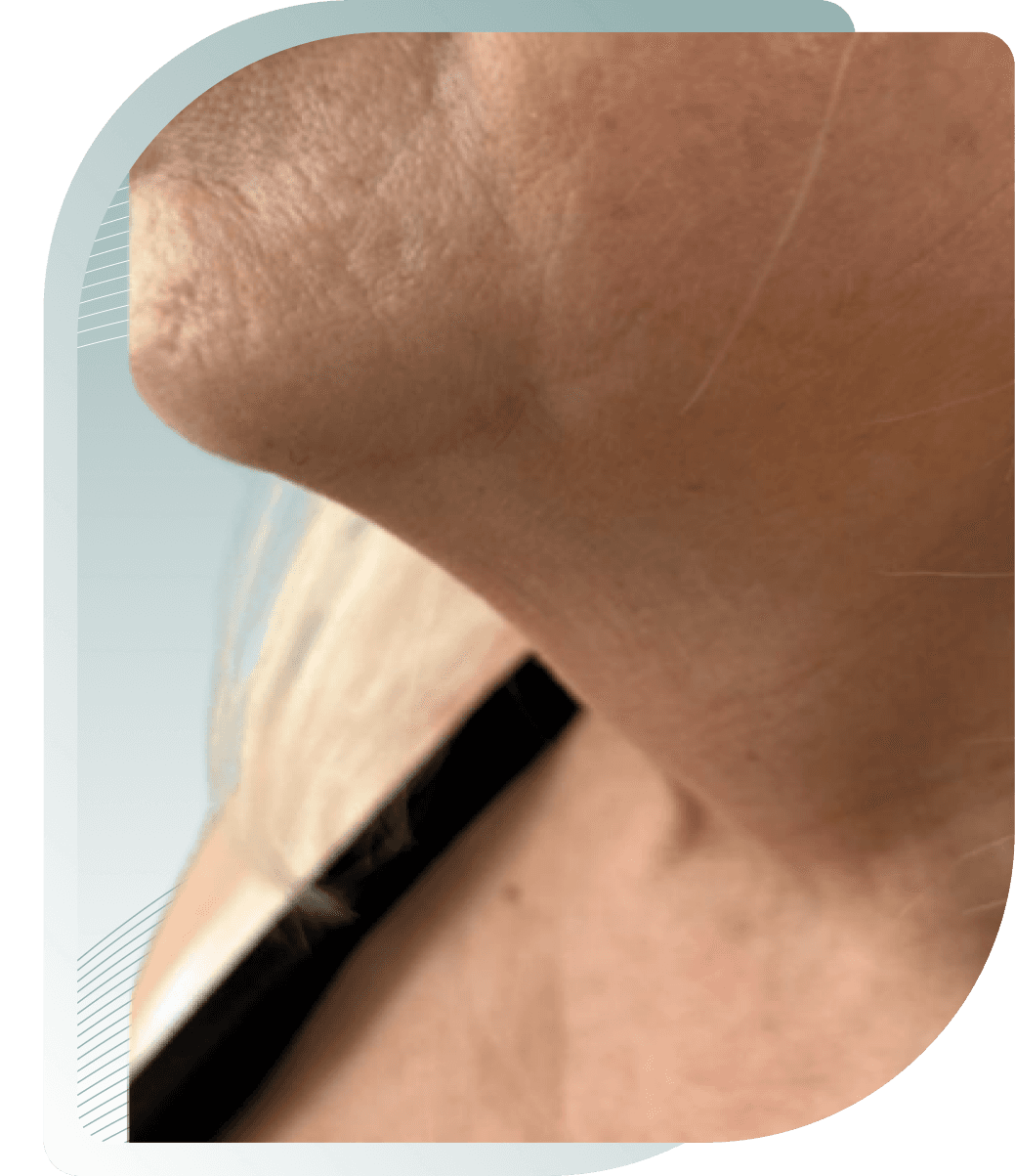 ULTIMATE FACELIFT RESULTS — Before photo (result 2 of 4)