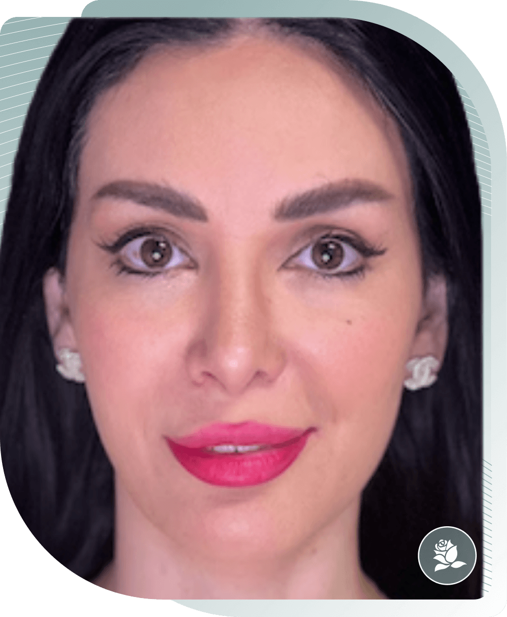 ULTIMATE FACELIFT RESULTS — After photo (result 3 of 4)