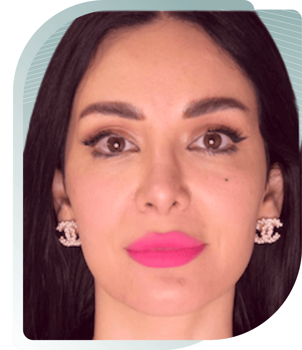 ULTIMATE FACELIFT RESULTS — Before photo (result 3 of 4)