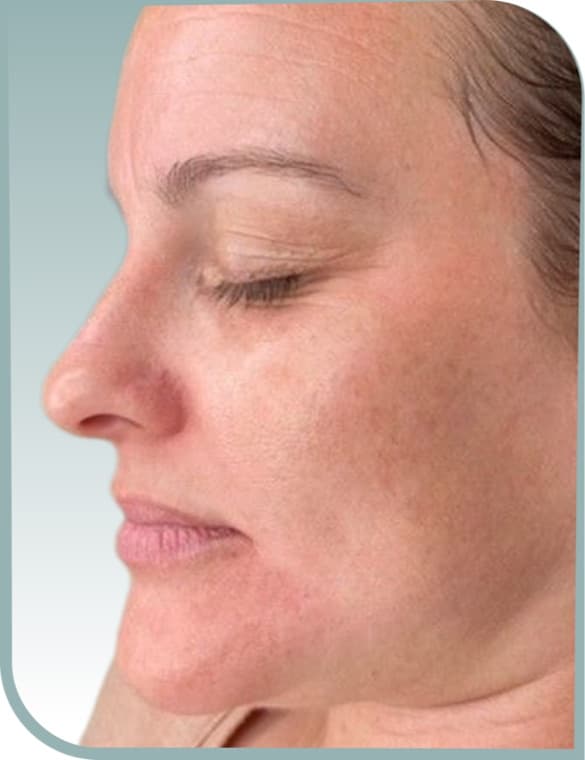 Cheek firmness lift, After photo (result 4 of 10)