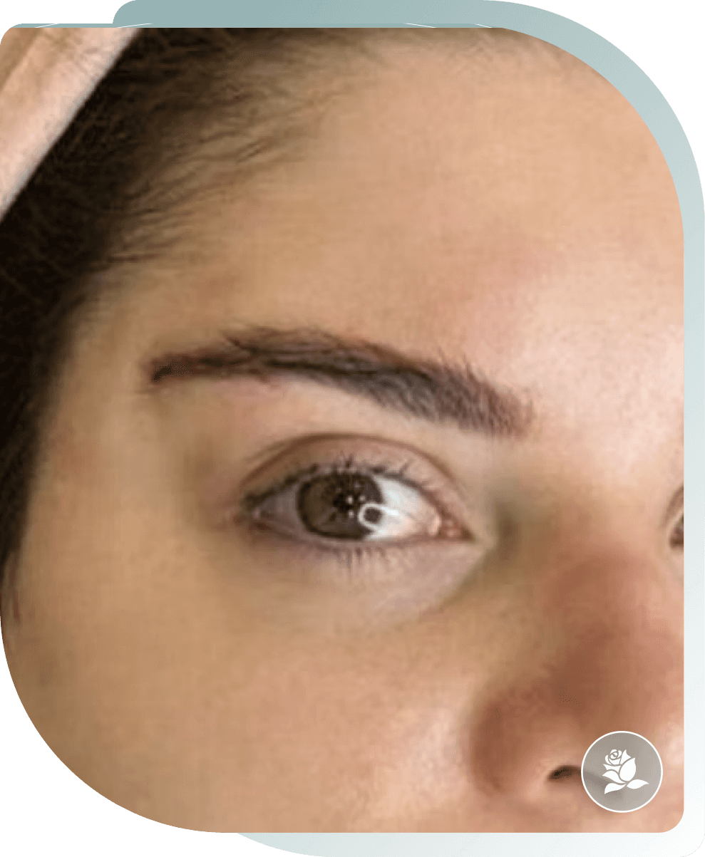 THREAD LIFT RESULTS — After photo (result 4 of 4)