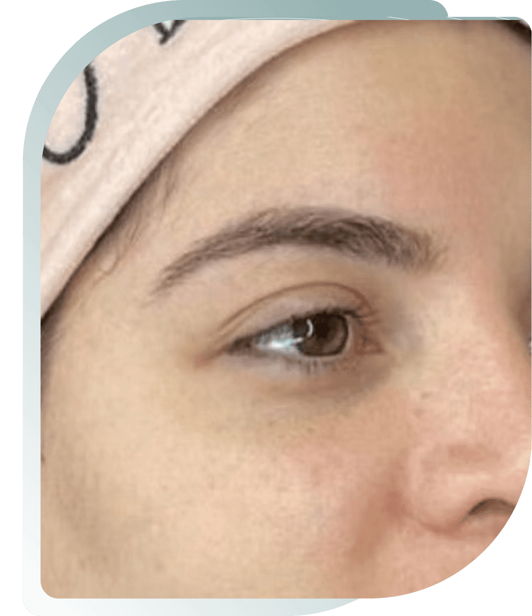 ULTIMATE FACELIFT RESULTS — Before photo (result 4 of 4)