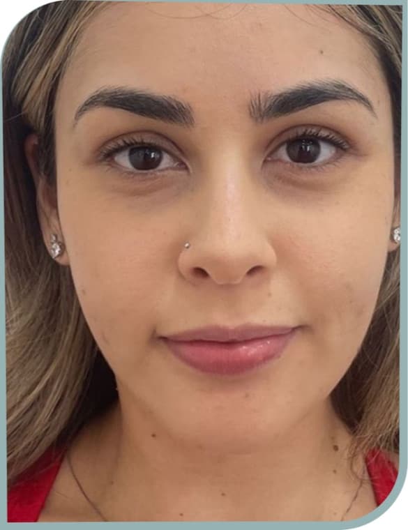 Under-eye brightening, After photo (result 5 of 10)