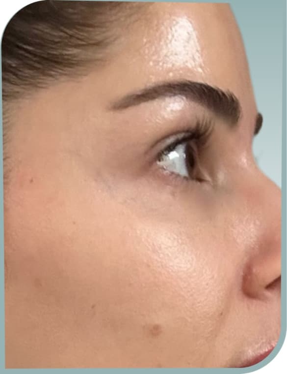 Under-eye smoothing lift, After photo (result 7 of 10)