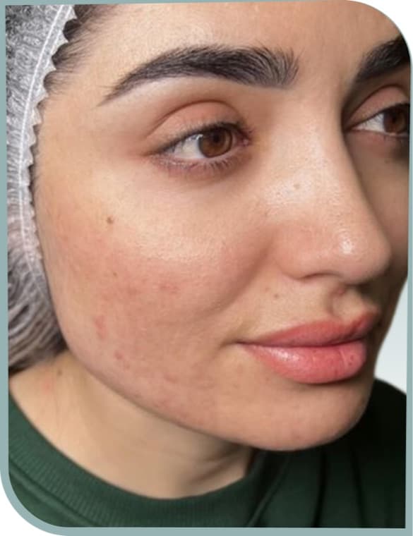 Cheek lift and smoothing, Before photo (result 8 of 10)