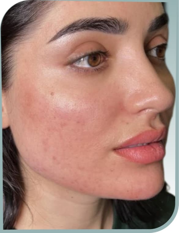Cheek lift and smoothing, After photo (result 8 of 10)