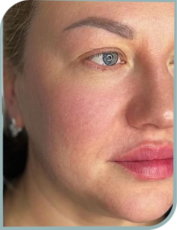 Cheek support lift, After photo (result 9 of 10)