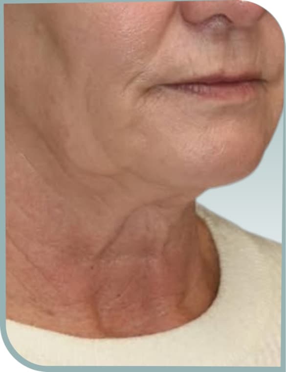 Jowl and neck laxity, Before photo (result 1 of 10)