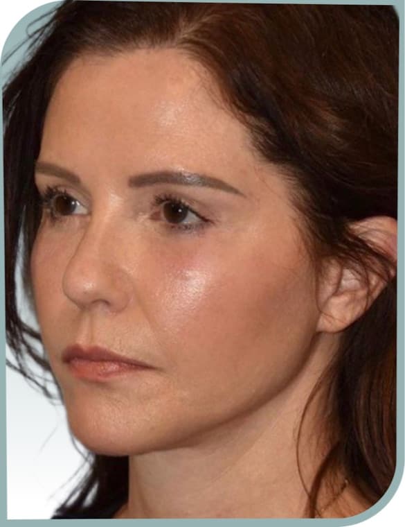 Midface and jaw, After photo (result 8 of 10)