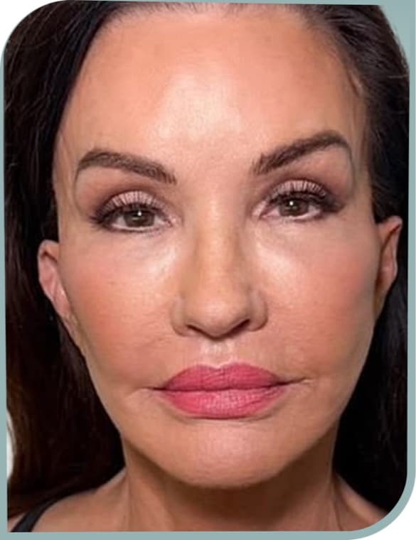 Overall facial laxity, After photo (result 10 of 10)
