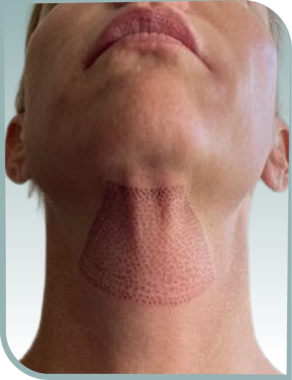 Submental tightening, Before photo