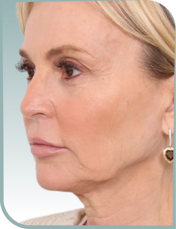 Jawline definition, Before photo (result 4 of 10)