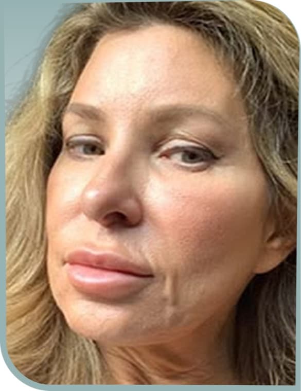 Lower face lift, Before photo (result 1 of 6)