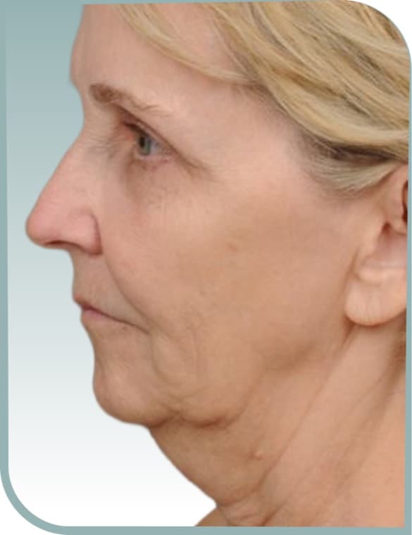 Jowl in profile, Before photo (result 6 of 10)