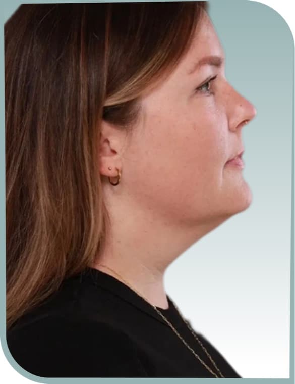 Jaw and neck contour, Before photo (result 7 of 10)