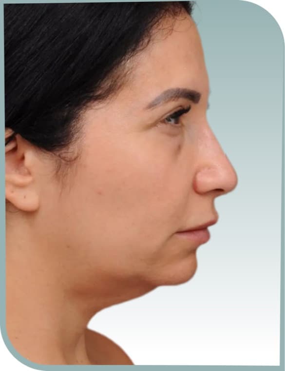 Midface and jaw, Before photo (result 8 of 10)