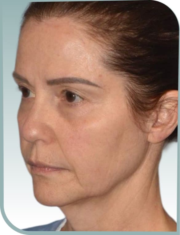 Submental fullness, Before photo (result 9 of 10)