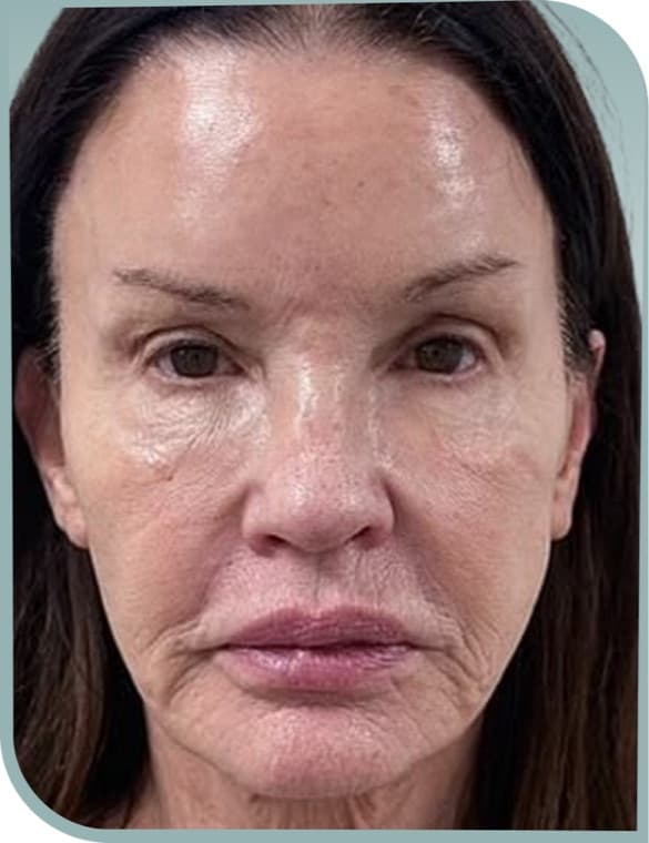 Overall facial laxity, Before photo (result 10 of 10)