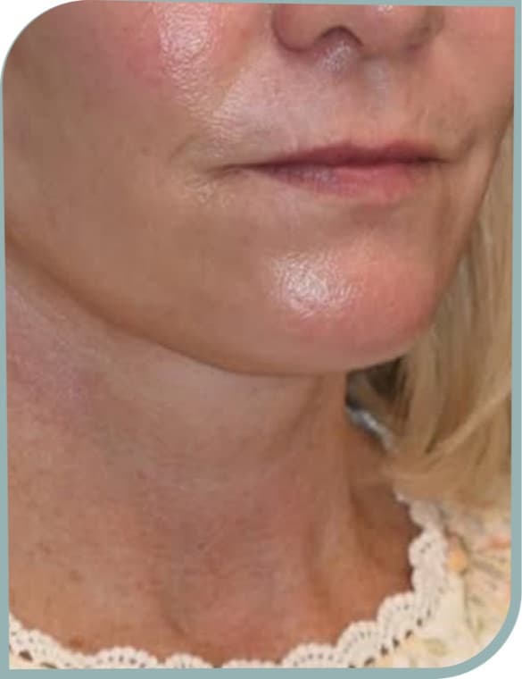 Jowl and neck laxity, After photo (result 1 of 10)