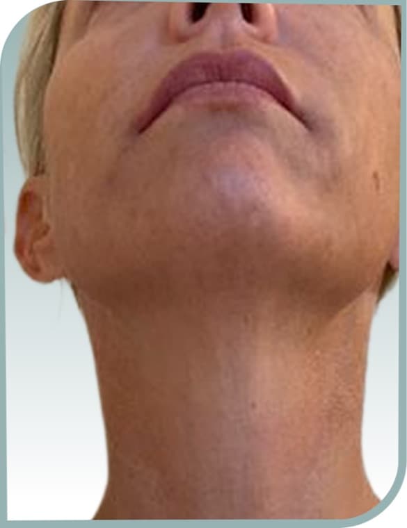 Submental tightening, After photo