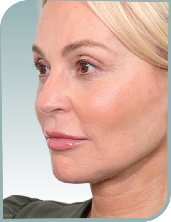 Jawline definition, After photo (result 4 of 10)