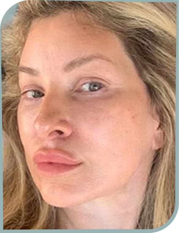 Lower face lift, After photo (result 1 of 6)