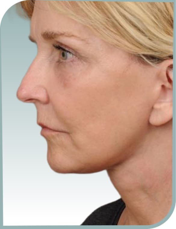 Jowl in profile, After photo (result 2 of 6)