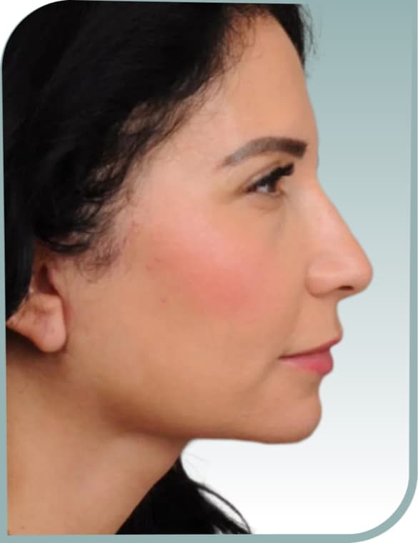 Jaw and neck contour, After photo (result 7 of 10)
