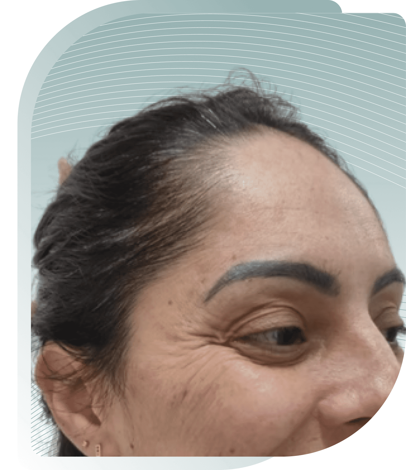 Before photo: Wrinkle Relaxing result at Carisma Aesthetics Malta